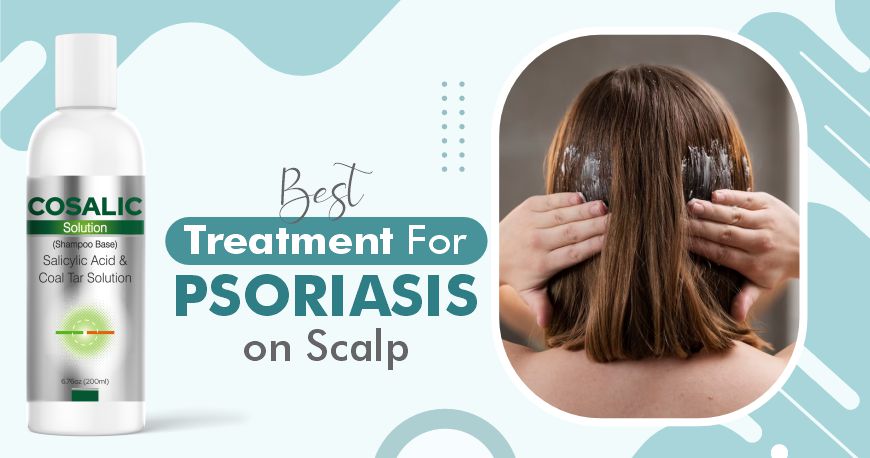 Treatment For Scalp Psoriasis
