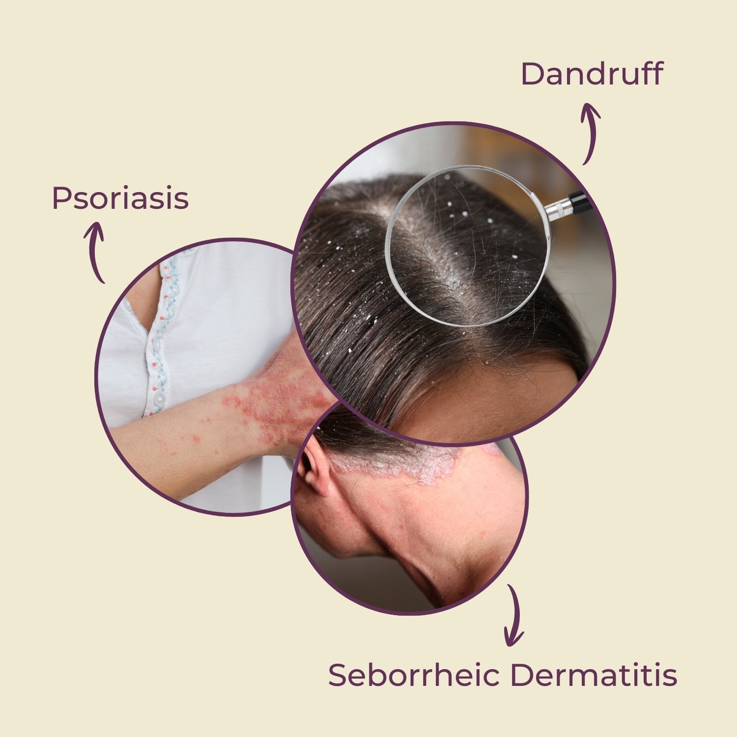Coal Tar for Psoriasis, Dermatitis, eczema lotion pack of 6
