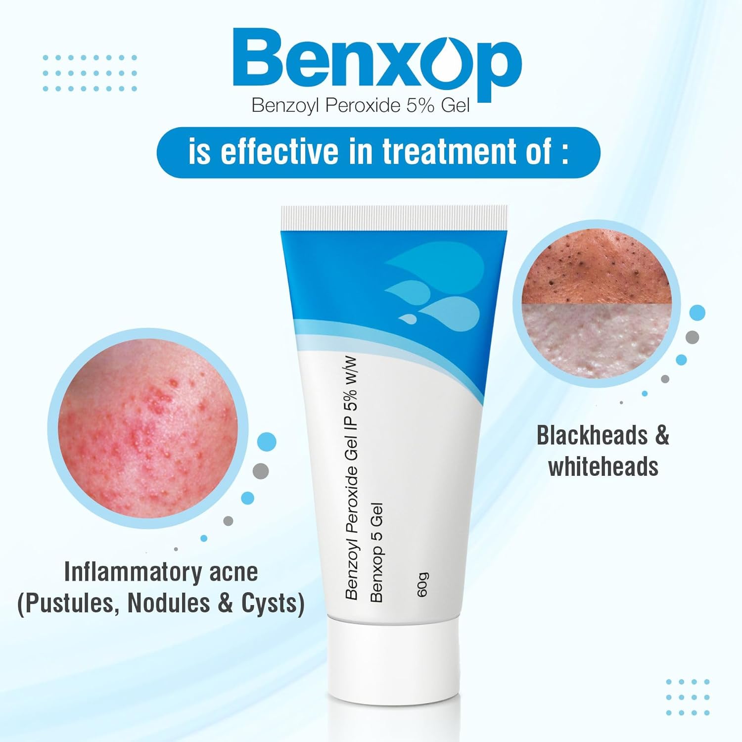 Salve Benxop Benzoyl Peroxide 5% Gel - 60 gm (2.11 Oz) | Powerful Acne Treatment for Pimples and Blemishes